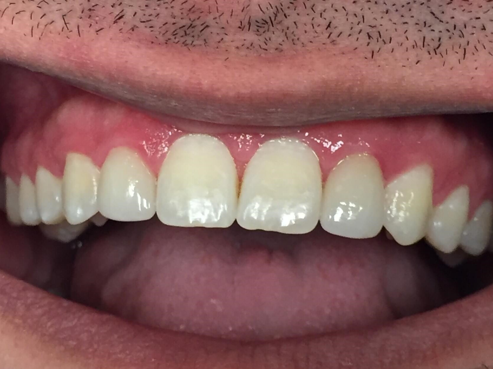 Veneers for Lateral Incisors After