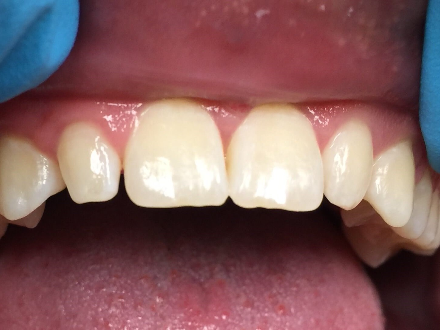 Veneers for Lateral Incisors Before