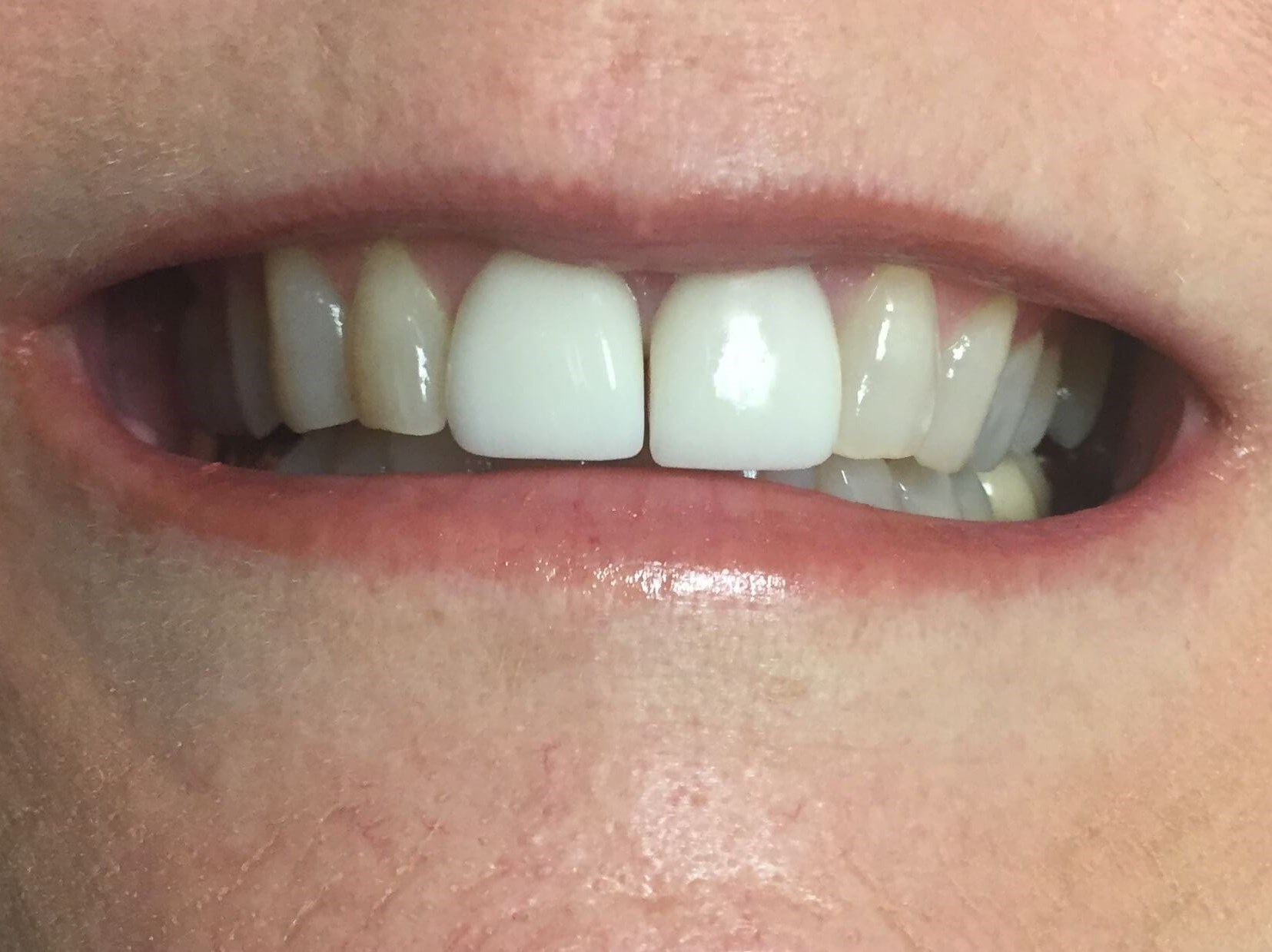 Veneers Lateral Incisor/Canine Before