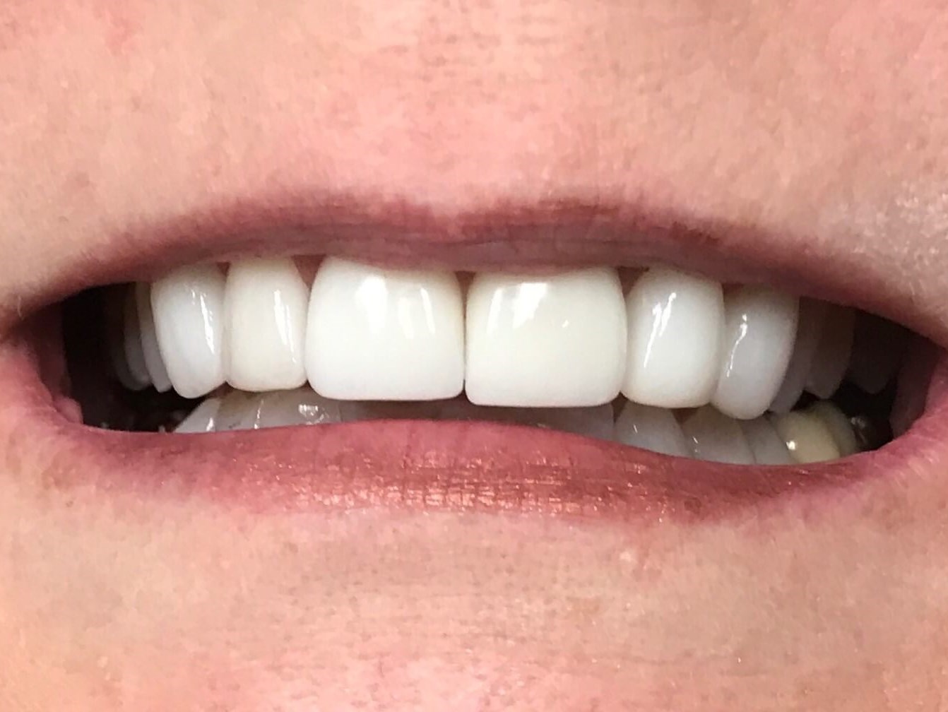 Veneers Lateral Incisor/Canine After