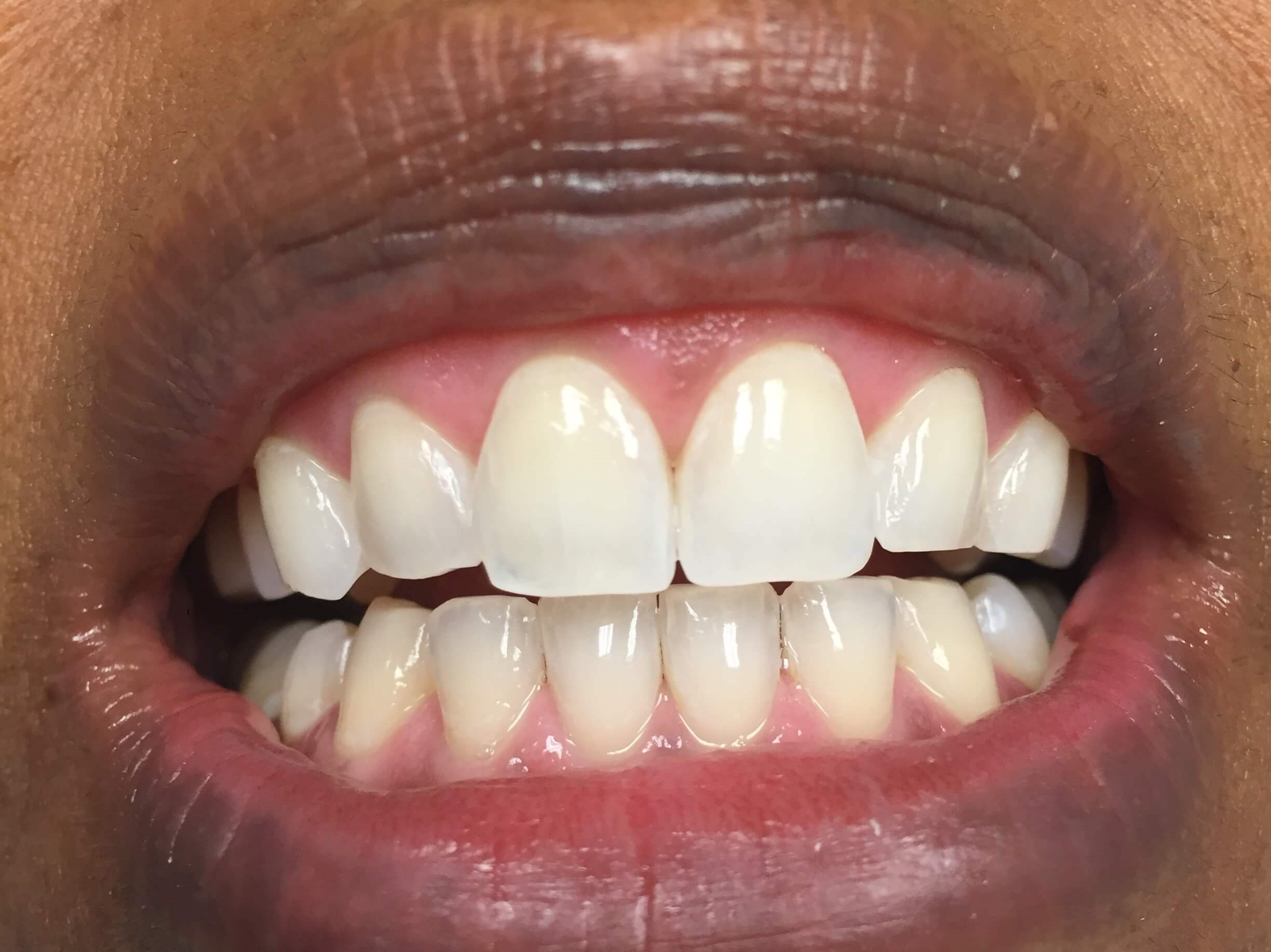Zoom! Whitening After