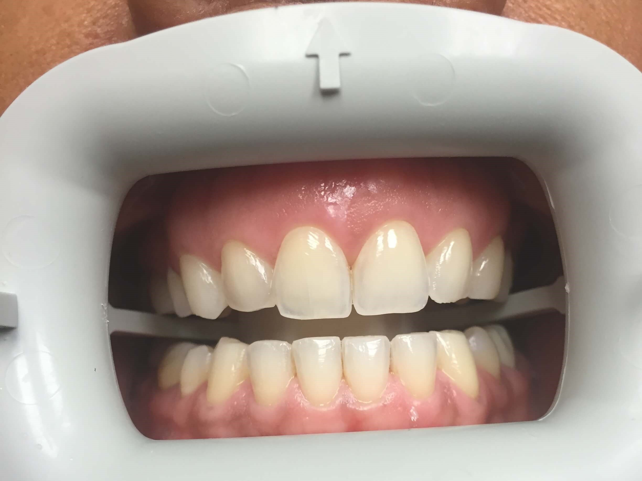 Zoom! Whitening Before