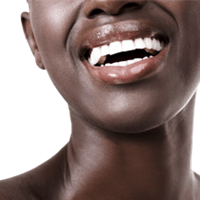 Smile Makeover